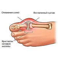 Фиксатор выпирающей косточки Valgus Pro Фото 2