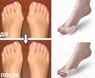 Гелевый корректор большого пальца VALGUS PRO. Акция! В полце Фото 4