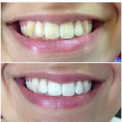 Безопасное отбеливание зубов! Фото 3